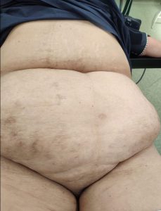 otylosc i HV przepuklina brzuszna,przepuklina pooperacyjna,przepuchlina,operacja przepukliny