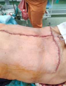 otylosc i HV pooper przepuklina brzuszna,przepuklina pooperacyjna,przepuchlina,operacja przepukliny