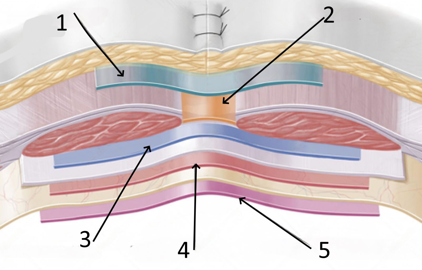 warstwy gdzie siatka przepuklina brzuszna,przepuklina pooperacyjna,przepuchlina,operacja przepukliny